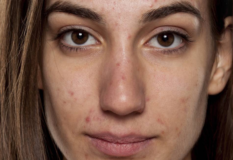 PS-Acne