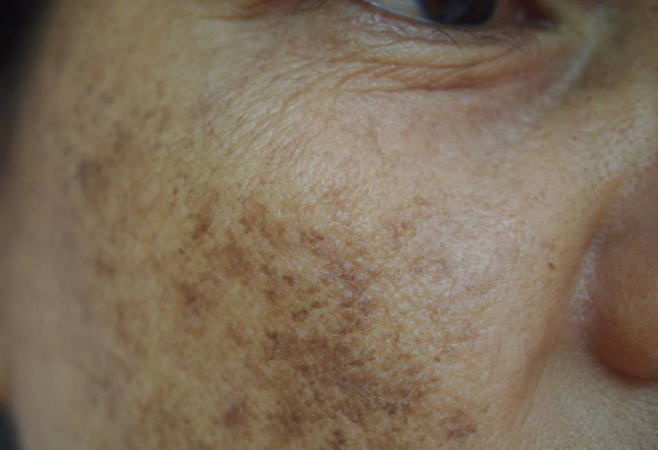 PS-pigmentation
