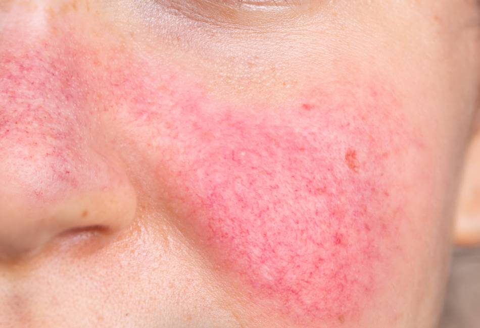 PS-rosacea